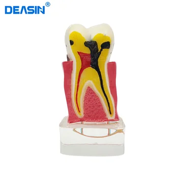 1бр Нов Зъболекарски Кабинет Жълто модул за Обучение Зъб Модел 4 Модел пъти Заболявания на Зъбите
